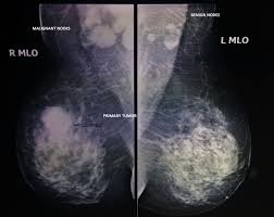 Most breast lumps are not cancerous, but it's always best to have them checked by a doctor. Inflammatory Breast Cancer Germany Pdf Ppt Case Reports Symptoms Treatment