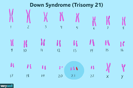 Down Syndrome Symptoms Causes Diagnosis Treatment