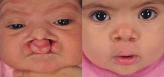 cleft lip repair cleft palate surgery