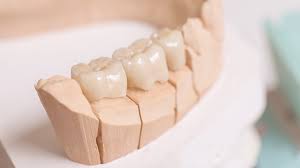 fixed dental bridge the best