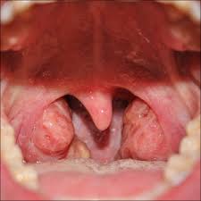 What throat cancer look like. Hypopharyngeal Cancer Aka Throat Cancer Weheal Org Weheal Org