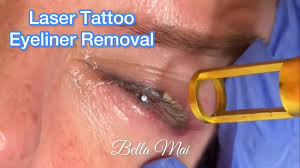 laser tattoo eyeliner removal treatment