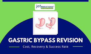 gastric byp revision cost