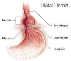 Hiatal Hernia Diet Tips Best Worst Food Choices And