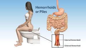 We did not find results for: 10 Things You Can Do About Hemorrhoids During Pregnancy Afromum