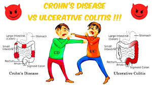Crohns Vs Ulcerative Colitis The Battle Of The Bowels