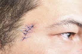 7 ways to minimize mohs surgery scars