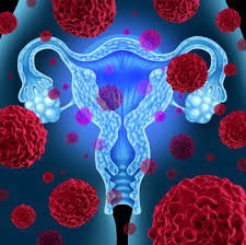 What does a stomach swollen from ovarian cancer look like? Ovarian Cancer Not As Fatal As Previously Thought Study Finds