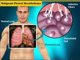 Magnetic resonance imaging can define invasion of the diaphragm or . Pin On Mesothelioma