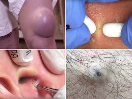 Hormonal changes can cause an increase in. The Best Pimple And Zit Popping Videos Of 2018 Insider