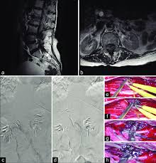 lumbar mri with and without contrast