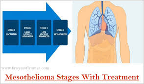 In many cases, a mesothelioma treatment plan developed for stage 4 patients will largely focus on helping to relieve some of these worsening in some cases, stage 4 mesothelioma patients have been able to extend their life expectancy through treatment, though it's important to keep in mind how. Mesothelioma Stages With Treatment Lawyers Firm Usa