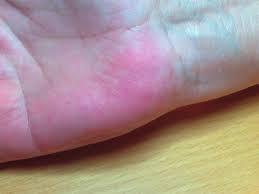 The degree of redness is often related to the severity of any underlying disease (if present). Https Www Karger Com Article Pdf 481855