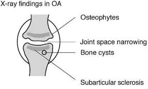 Osteoarthritis of the talonavicular joint with pseudarthrosis of     SlidePlayer Osteoarthritis    Osteoarthritis    