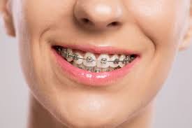 As the name suggests, these devices do not require the brackets to attach to the teeth and can therefore be removed by the patient. Wearing Braces How Long Do Braces Take To Work