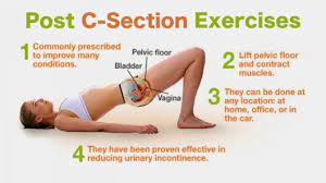 physiotherapy exercise after cesarean