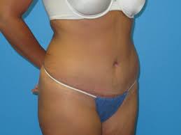 organs can affect tummy tuck results