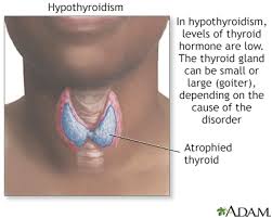 hypothyroidism underactive thyroid