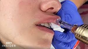 Lip enhancement procedure uses the hyaluron pen to deliver hyaluronic acid into the lips, restoring some of its plump. Needle Less Lip Fillers Give You Fuller Lips Instantly Youtube