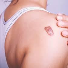 keloid causes symptoms and common