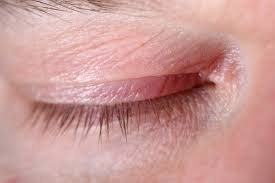 psoriasis on eyelids and other