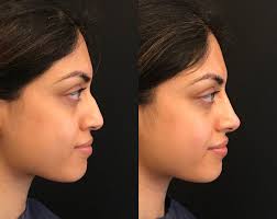 your nose smaller without surgery