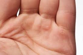 remove calluses naturally from hands