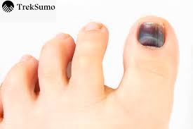 the hikers guide to black toenails