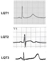 Long Qt Syndromes And Torsade De Pointes The Cardiology