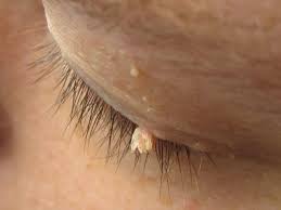 types of warts pictures symptoms and