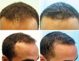 Hair loss can be originated from several factors, such as stress, health issues, accidents, medications, etc. Black Men Fue Hair Transplant Using 1200 Grafts