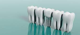how much do dental implants cost art