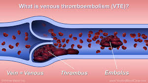 venous thromboembolism ile ilgili görsel sonucu