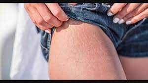 worried about stretch marks know how