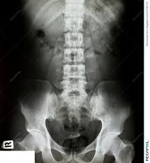 Hemi pelvis anatomy normal ap. X Ray Of The Pelvis Stock Photo 53765157 Megapixl