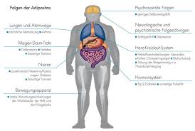 Adipositas (fettleibigkeit, fettsucht) ist ein chronischer zustand, bei dem sich im körper mehr fettgewebe ansammelt als normal, sodass das körpergewicht. Adipositas Starkes Ubergewicht