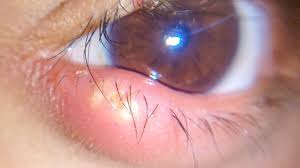 stye on lower eyelid symptoms causes