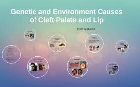 cleft palate and lip by kate delellis