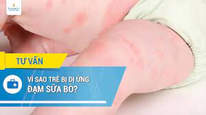 Dị ứng thức ăn ở trẻ sơ sinh