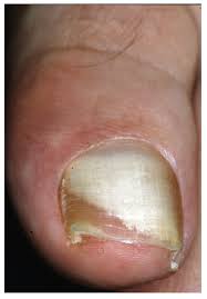 jof free full text onychomycosis a