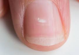 health problems your fingernails can
