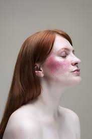 myths i was told believed about rosacea