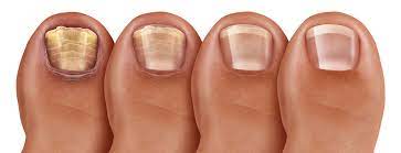 thick discolored toenails cal