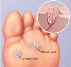 plantar wart therapy sydney foot clinic