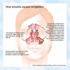 sinus infections advanced cardiology