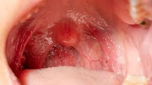 Human papillomavirus (hpv) is a group of viruses that are extremely common worldwide. World First Saliva Test Detects Occult Hpv Oral Cancer