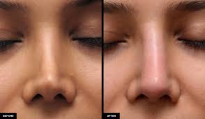 Don't touch or rub the treated area for at least six hours after treatment. Nonsurgical Revision Rhinoplasty In San Francisco Dr David Mabrie