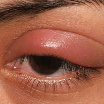 swollen eyelid know the causes