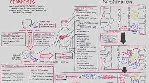 The initial stage of liver cirrhosis is actually called 'compensated stage', as the body successfully manages and compensates on its own for all the shortcomings that. Liver Cirrhosis Sands Pathophysiology Investigations Management Youtube