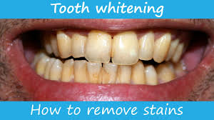 Let it stand for a few minutes and then rinse it off with clean water. How To Remove Stains From The Teeth Youtube
